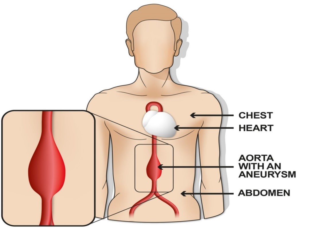 Cartoon man with arrows pointing to Chest, Heart, Aorta with an Aneurysm and abdomen